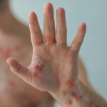 intro-pic-mpox-hand
