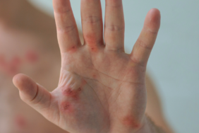 intro-pic-mpox-hand