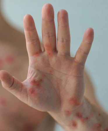 intro-pic-mpox-hand