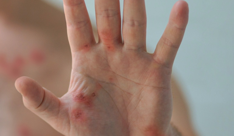 intro-pic-mpox-hand